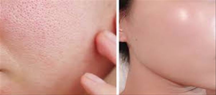 Easy remedy for open pores of skin!!