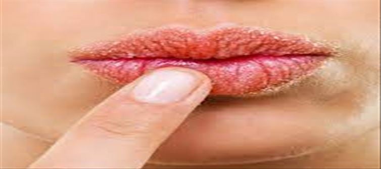 Home Remedies for Chapped Lips!!!