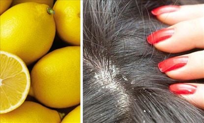 Getting rid of Dandruff naturally 