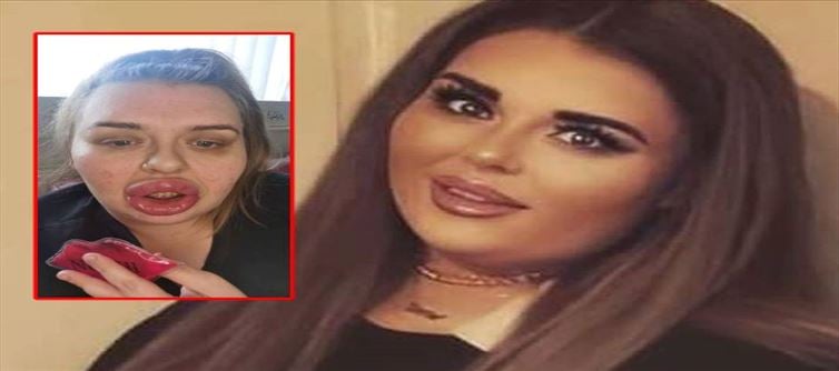Six times larger lip? Disaster for the woman..!?