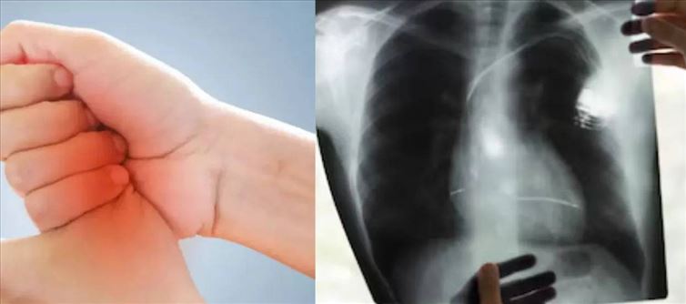 These 2 Signs are seen on the Hands due to Lung Cancer - How to Save Yourself?