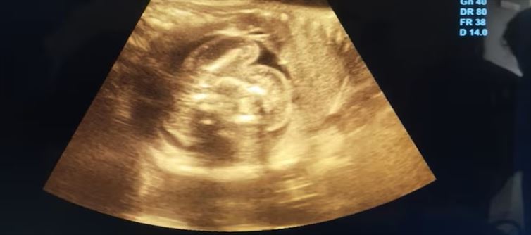 Foetus inside foetus - Maharashtra Doctors Baffled