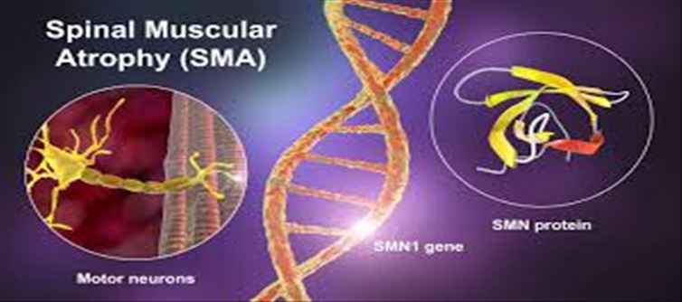 How many spinal muscular atrophy patients are there in India?