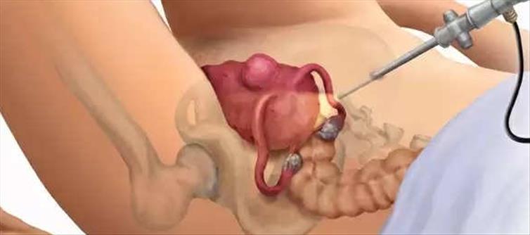 Is Uterus Removal Safe for Women or Not? What Are The After Effects?