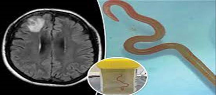 Snake in Woman's Brain? Rare Parasitic Infection Baffles Doctors.!