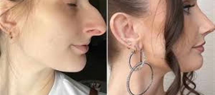 The woman divorced her husband after nose surgery..!?