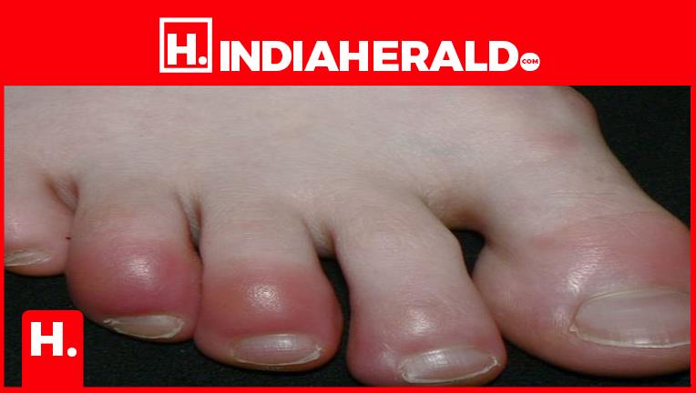 Does your skin itch in winter? These are the serious reason