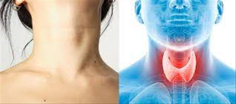 Changing your lifestyle will cure Thyroid condition!!!