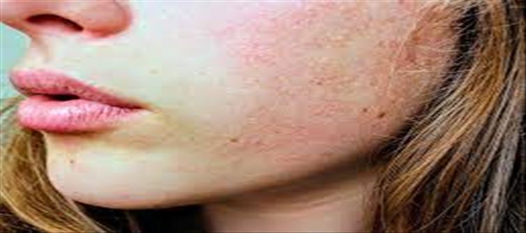 Effects on face due to vitamin deficiency...