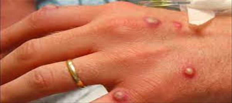 New Monkeypox case - What is the method of prevention?