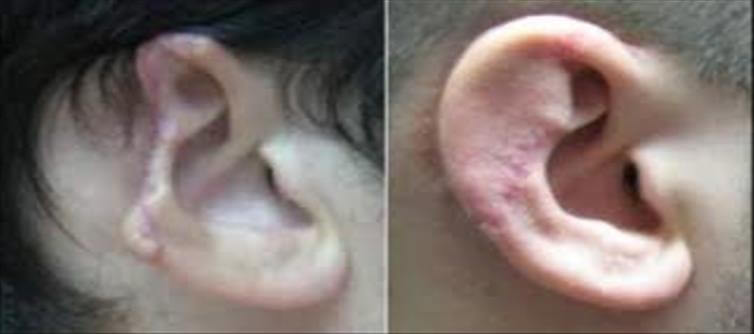 Preventing Ear Infections Through Healthy Habits.!