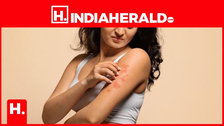 Psoriasis Linked To Gut Infection And Multiplied Danger Of Crohn's Sickness - India Herald