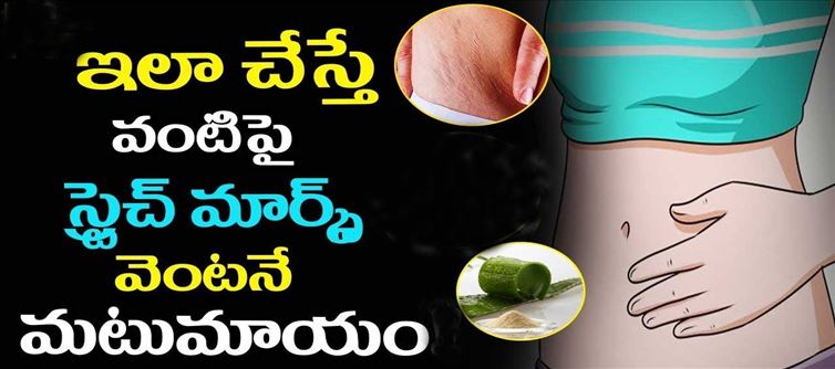 తక్కువ ఖర్చుతో పొట్టపై స్ట్రెచ్ మర్క్స్ పోగొట్టుకోండిలా..!