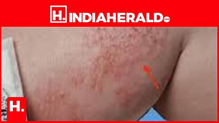 Seven skin symptoms indicating nutrition d deficiency.