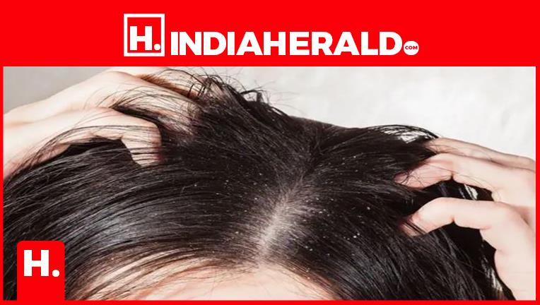 Simple Tips to Get Rid of Dandruff.. ? Home Remedies.. Simple Tips to Get Rid of Dandruff.. ? Home Remedies..