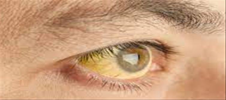 What do yellow or red eyes say about your health..!?