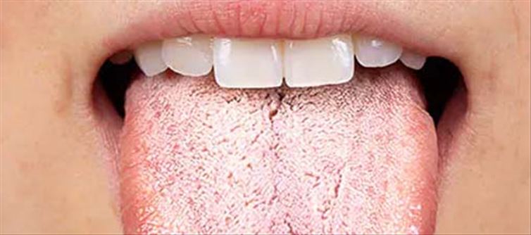 White Tongue Reason Due to these diseases, white layer starts accumulating