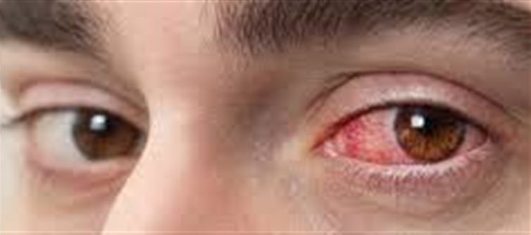 How to avoid eye bacteria during monsoon?Take care in this way!