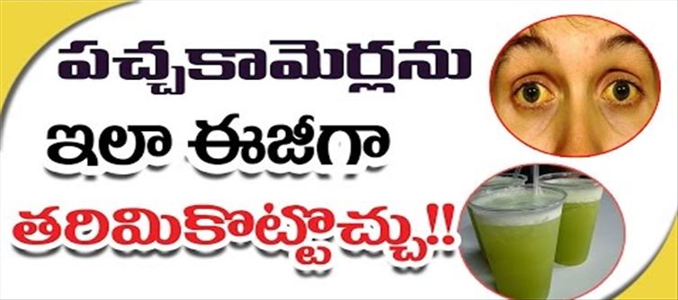 లైఫ్ స్టైల్:పచ్చకామర్ల తో బాధపడుతున్న వారు దీనితో బై బై చెప్పండి..!!