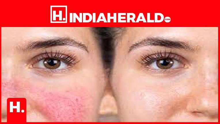 Red Marks On The Face Is A Sign Of Serious Illness red-marks-on-the-face-is-a-sign-of-serious-illness