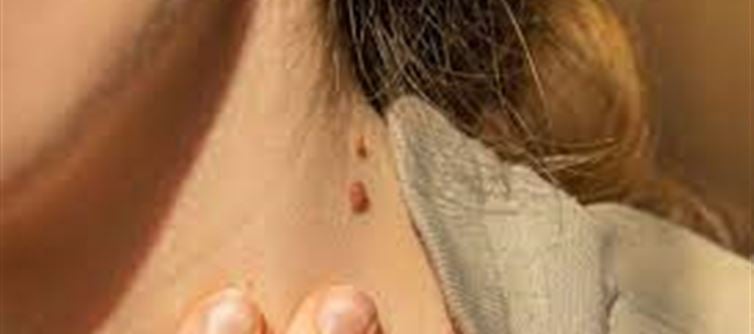Why do warts appear on the body, when is it a danger signal?