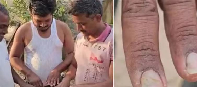 ఆ జిల్లాలో వింత వ్యాధి కలకలం..ఏకంగా మనుషుల గోళ్ళు, జుట్టు ..!