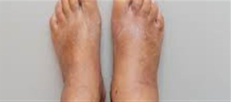 "Common Heart Failure Signs Affect Ankles."