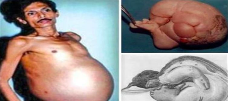 Pregnancy for a Man..!? Shocking..!
