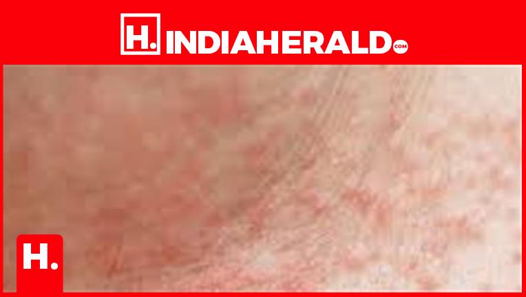 Summer Human Rashes Tips For Treating And Preventing Summer Rashes Caused By He